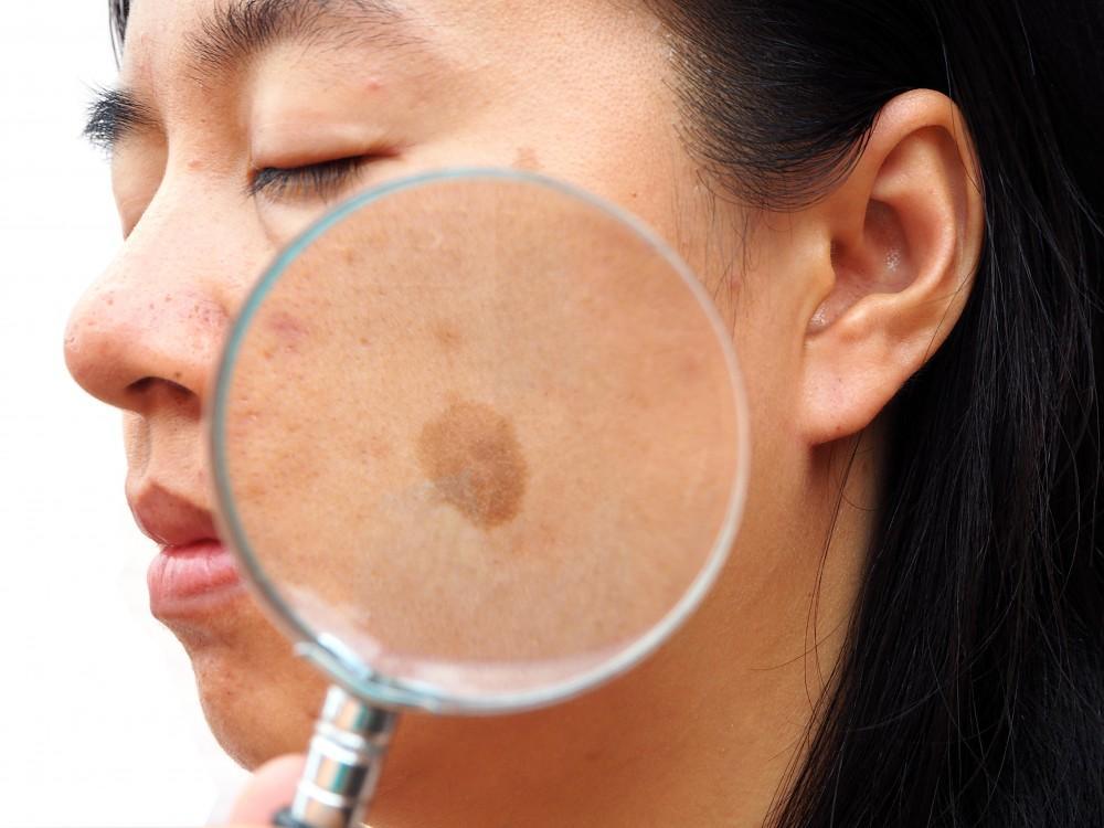 discovery pico for melasma