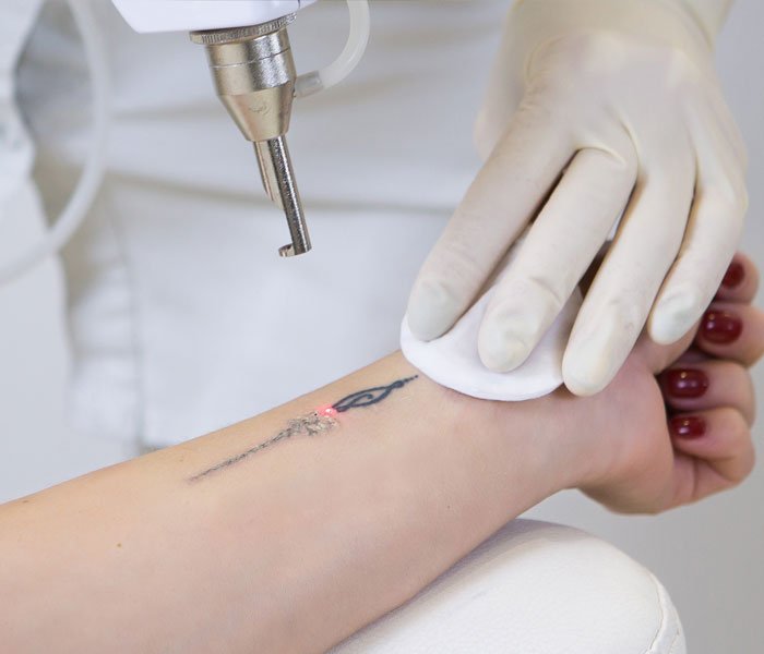 Discovery Pico Laser Tattoo Removal