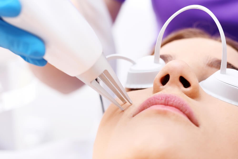 Best Laser Treatment for Acne Scars