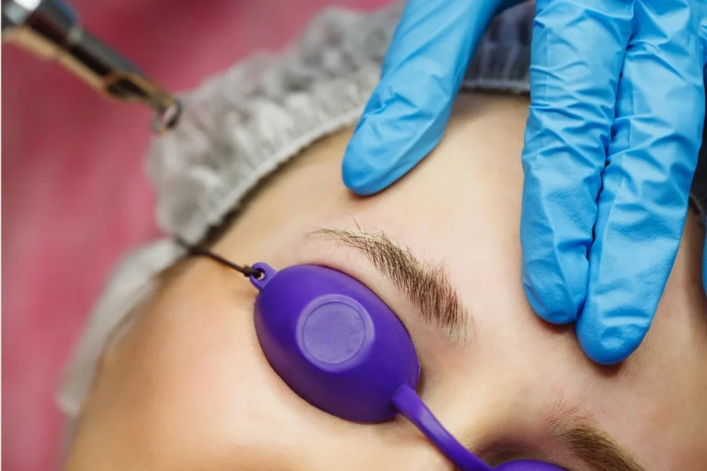 fractional picosecond laser treatment