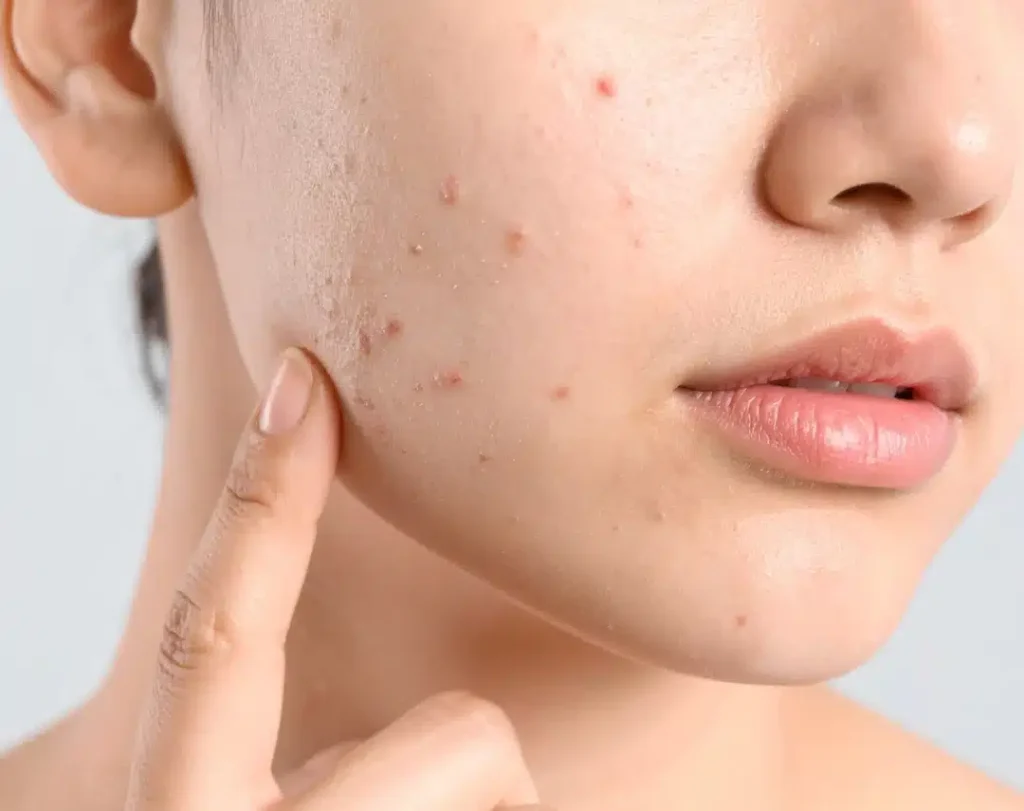 Best Laser Treatment for Acne Scars