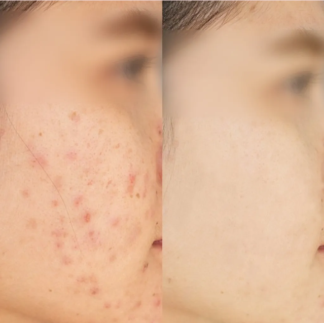 Discovery Pico laser acne scars