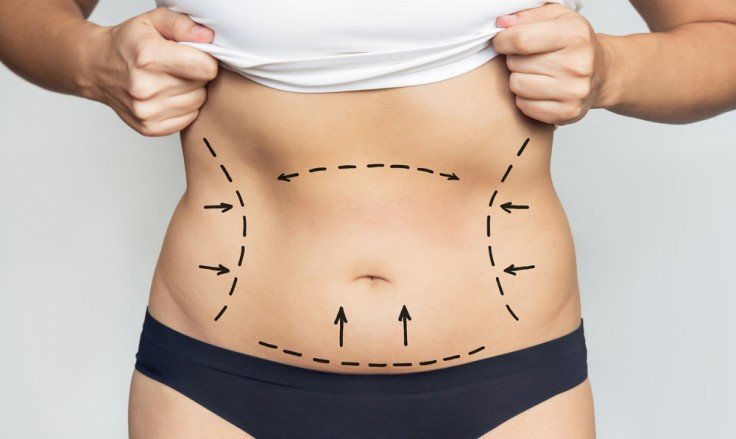 How much does laser fat removal cost