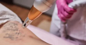 Best Tattoo Removal in Syria