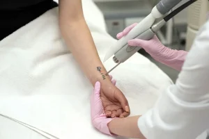 Tattoo Removal in Iraq