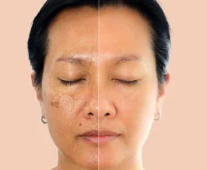Pigmentation Treatment in Iraq
