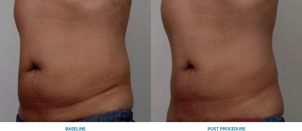 ultraformer 3 before and after
