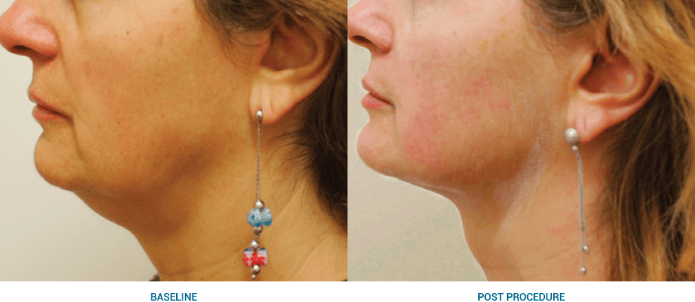ultraformer 3 before and after