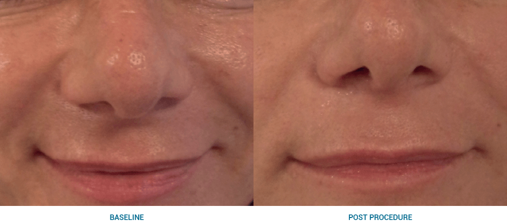 ultraformer 3 before and after
