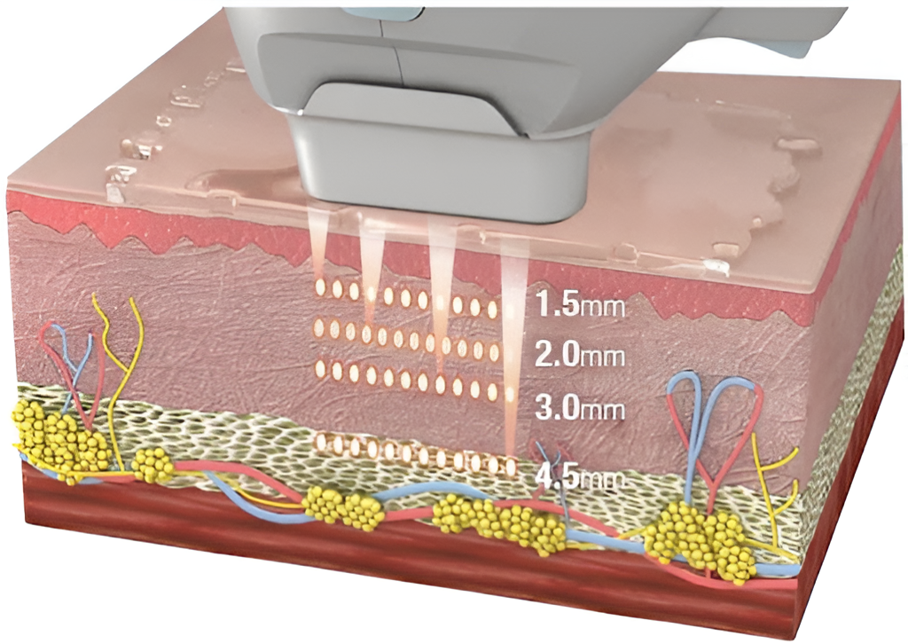 How Ultraformer MPT Works​